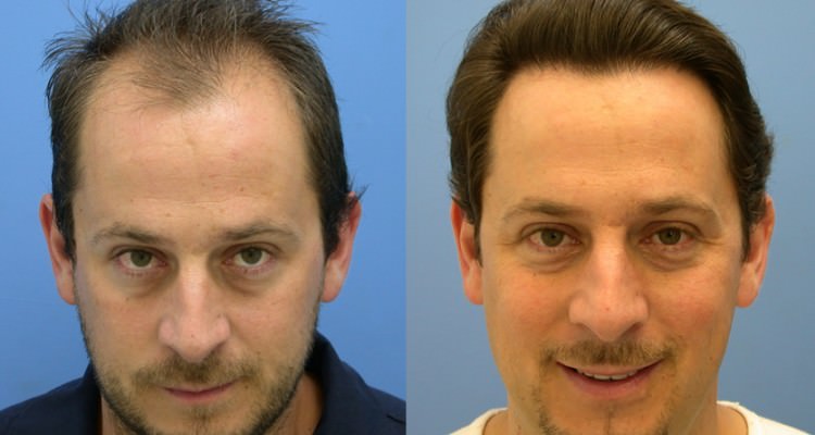 stop baldness regrow hair naturally